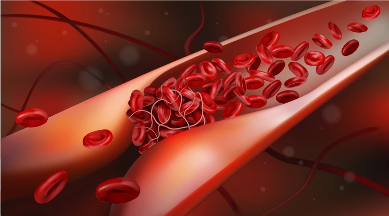 blood clots