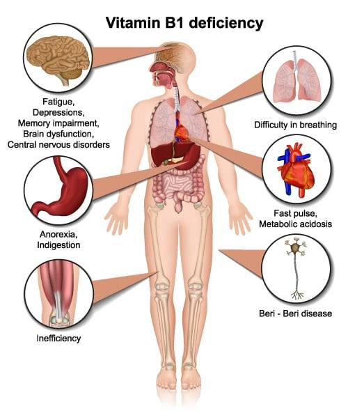 Vitamin B1 Deficiency