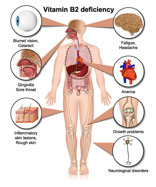 vitamin b2 deficiency